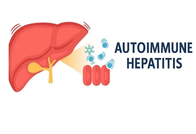 Autoimmune Hepatitis in Children