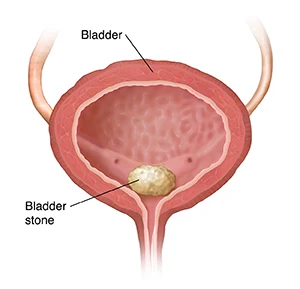Bladder Stone in Children