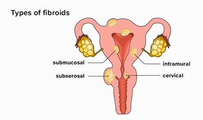 Fibroids