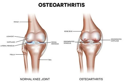 Osteoarthritis