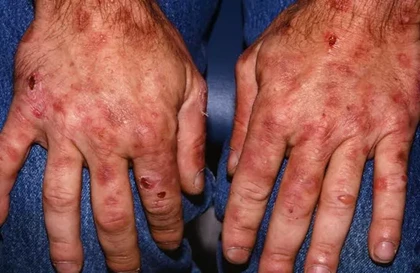 Porphyria