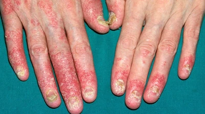 Psoriatic Arthritis