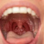 Recurrent Tonsillitis in Children: Causes, Symptoms and Homeopathic Support