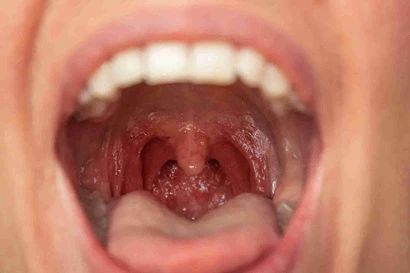 Recurrent Tonsillitis in Children