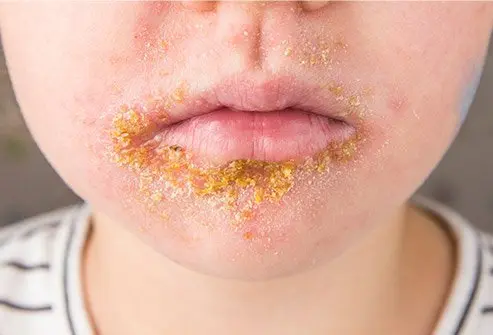 impetigo