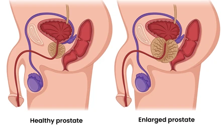Benign Prostatic Hyperplasia (Enlarged Prostate)