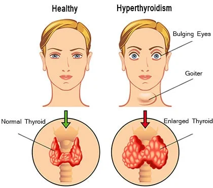Hyperthyroidism (Overactive Thyroid)
