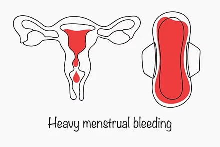 Menorrhagia (Heavy Periods)